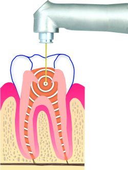 laser_root_canal