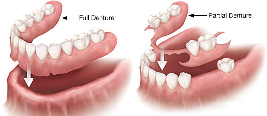 انواع دندان مصنوعی 