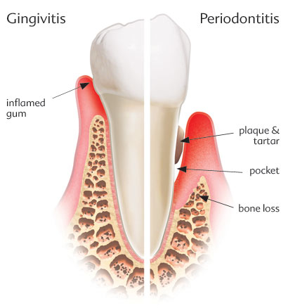 gingivitis periodontal pocket