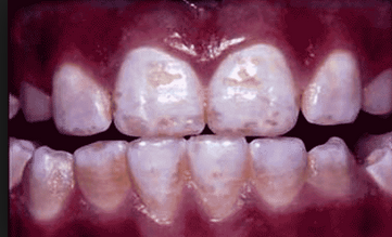 dental fluorosis 1