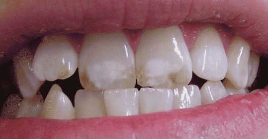 dental fluorosis 2