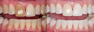 teeth whitening melbourne