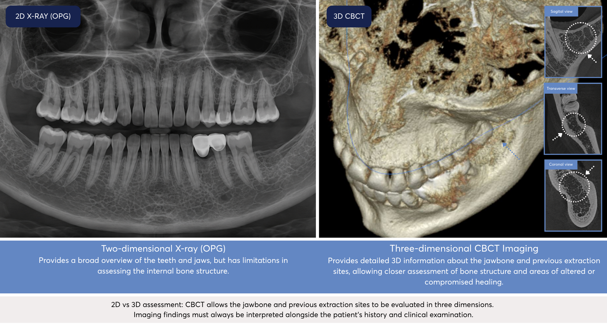 2D panoramic dental X-ray compared with 3D CBCT imaging used to assess jawbone structure, previous extraction sites and suspected jawbone cavitations or NICO lesions.