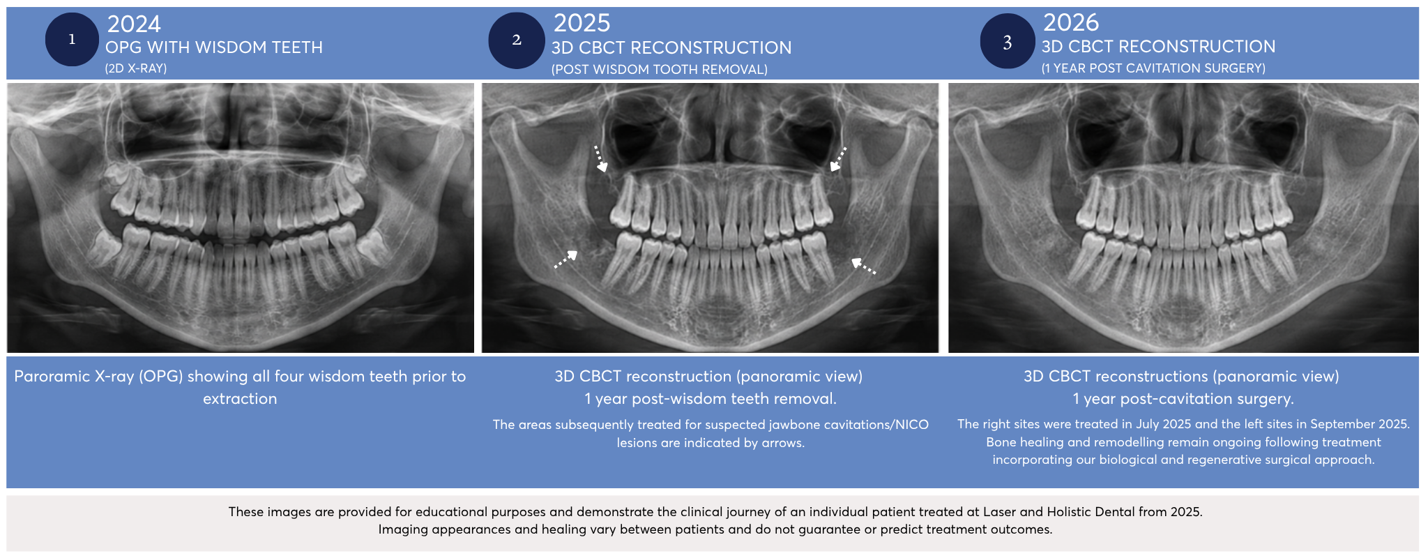 Comparison of a 2D panoramic dental X-ray and 3D CBCT imaging used to assess jawbone cavitations and suspected NICO lesions.